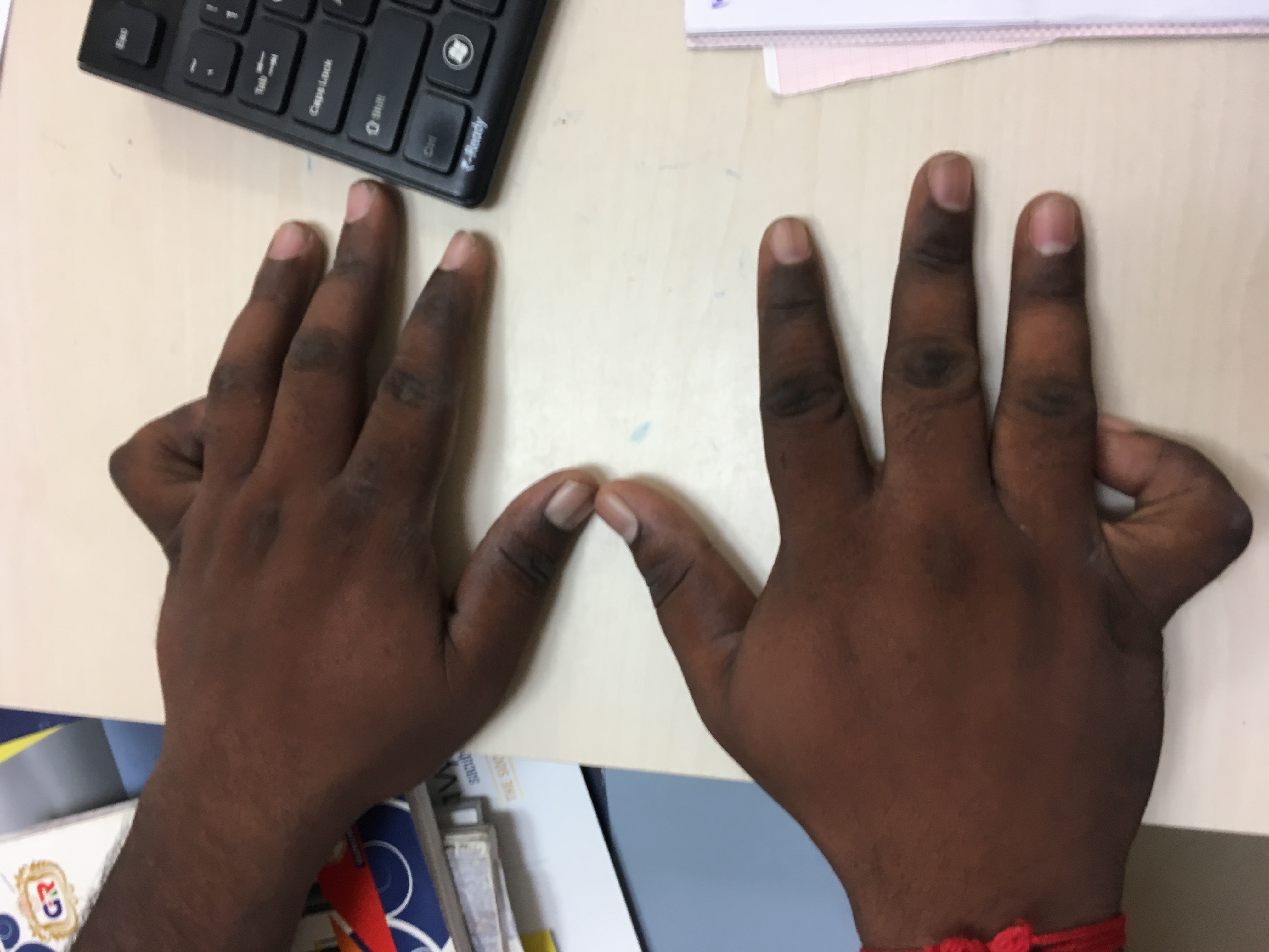 What Is This Genetic Physical Abnormality?
